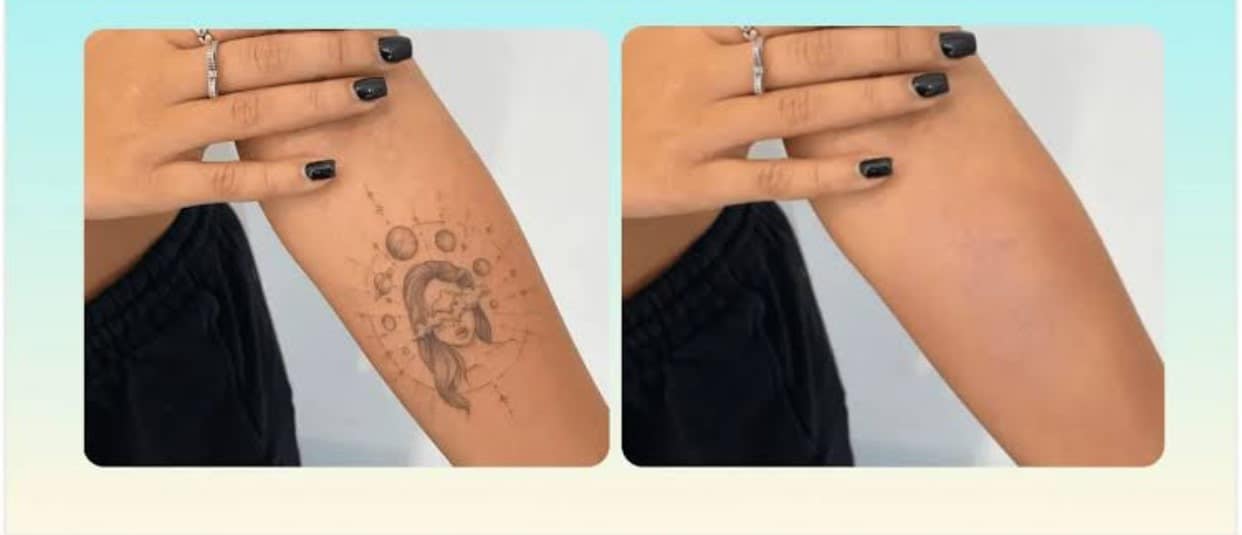 removing tattoo from photo