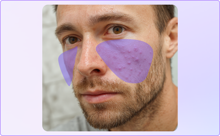 select blemishes on face