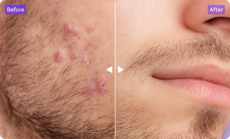 remove acne from pictures