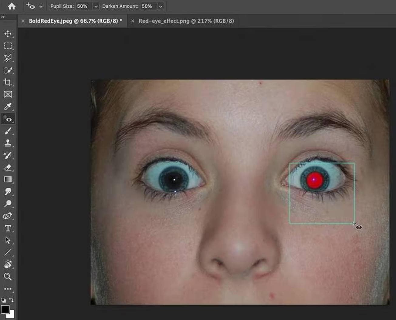 Repeat for each affected eye